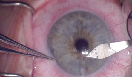 Glaucoma Surgery